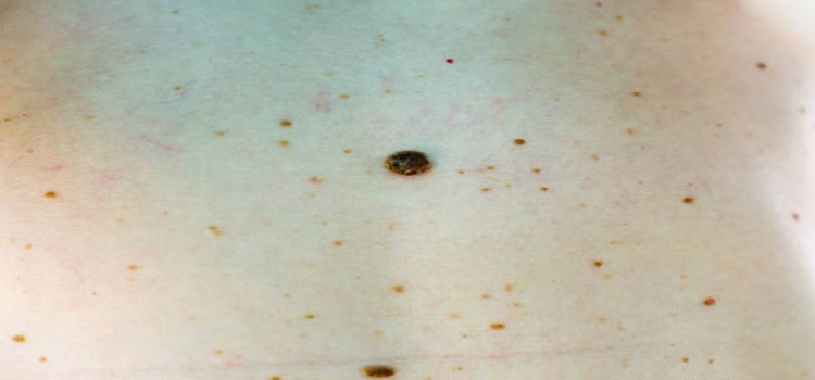Skin Cancer Tuscon
