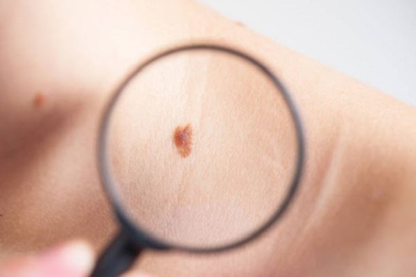 Skin Cancer Tucson