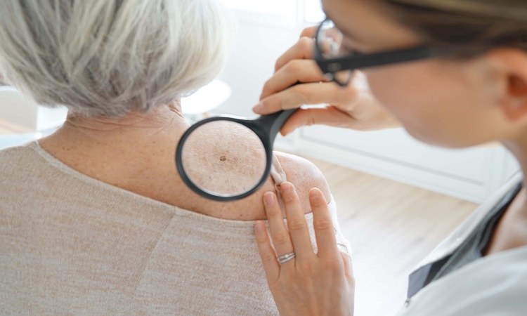 Skin Cancer Tucson