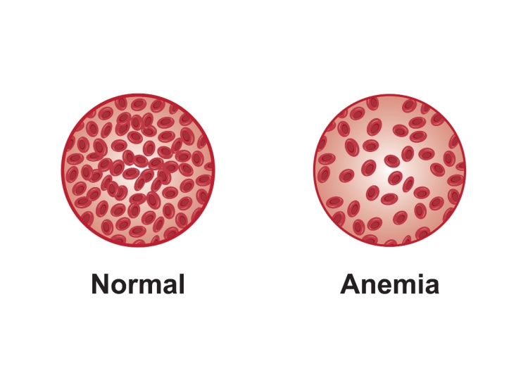 Scientific Designing of Anemia Symptoms. Normal and Anemia Blood Comparison. Colorful Symbols. Vector Illustration.